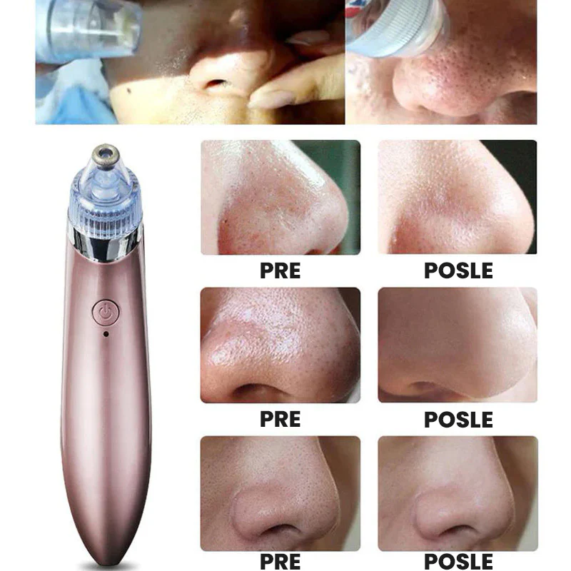 ✨ Dermasuction – aparat za uklanjanje mitisera i dubinsko čišćenje pora!