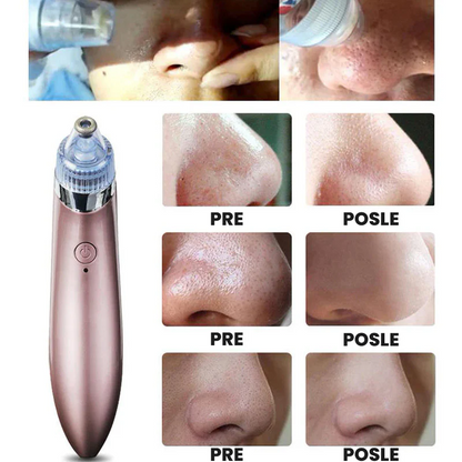 ✨ Dermasuction – aparat za uklanjanje mitisera i dubinsko čišćenje pora!
